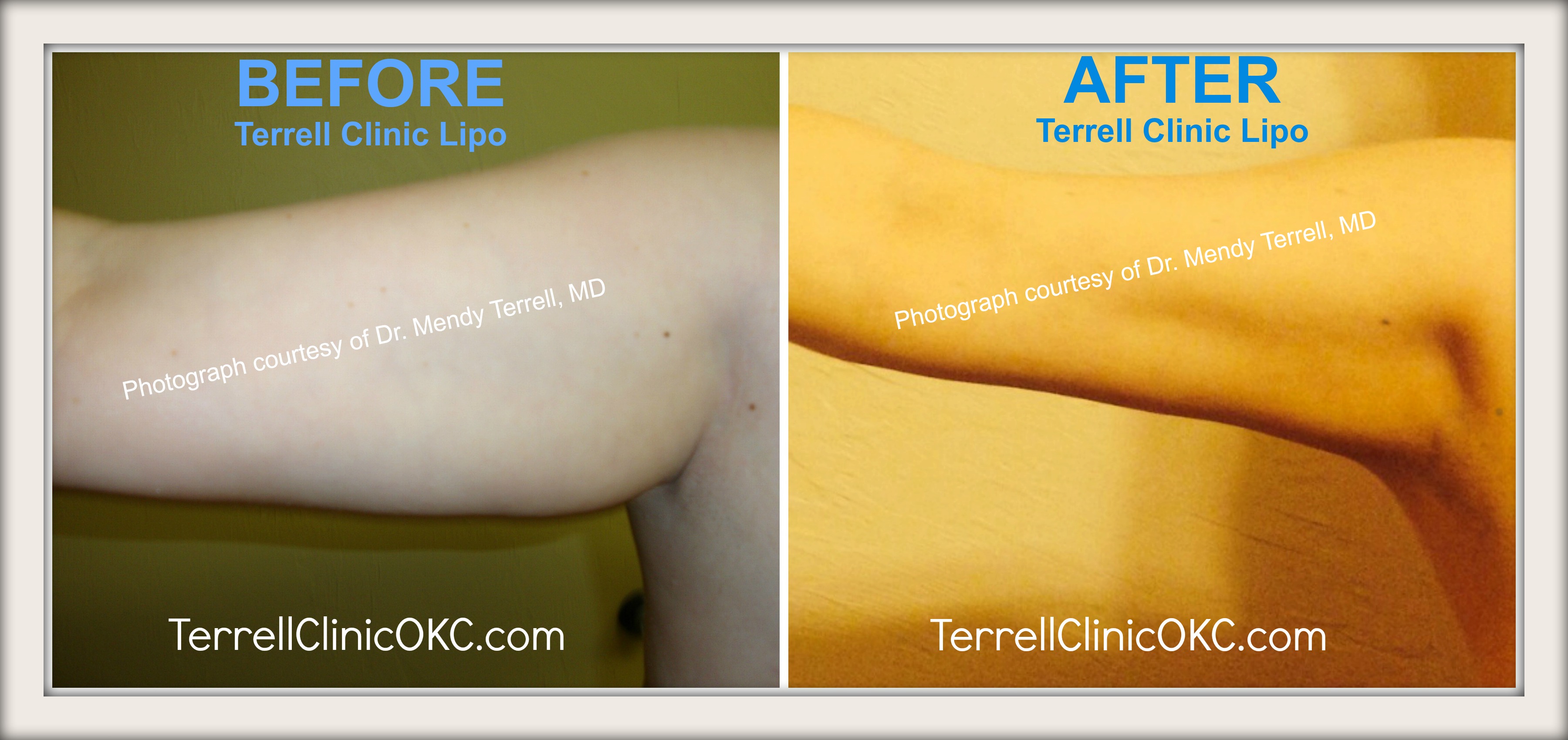 liposuction upper back