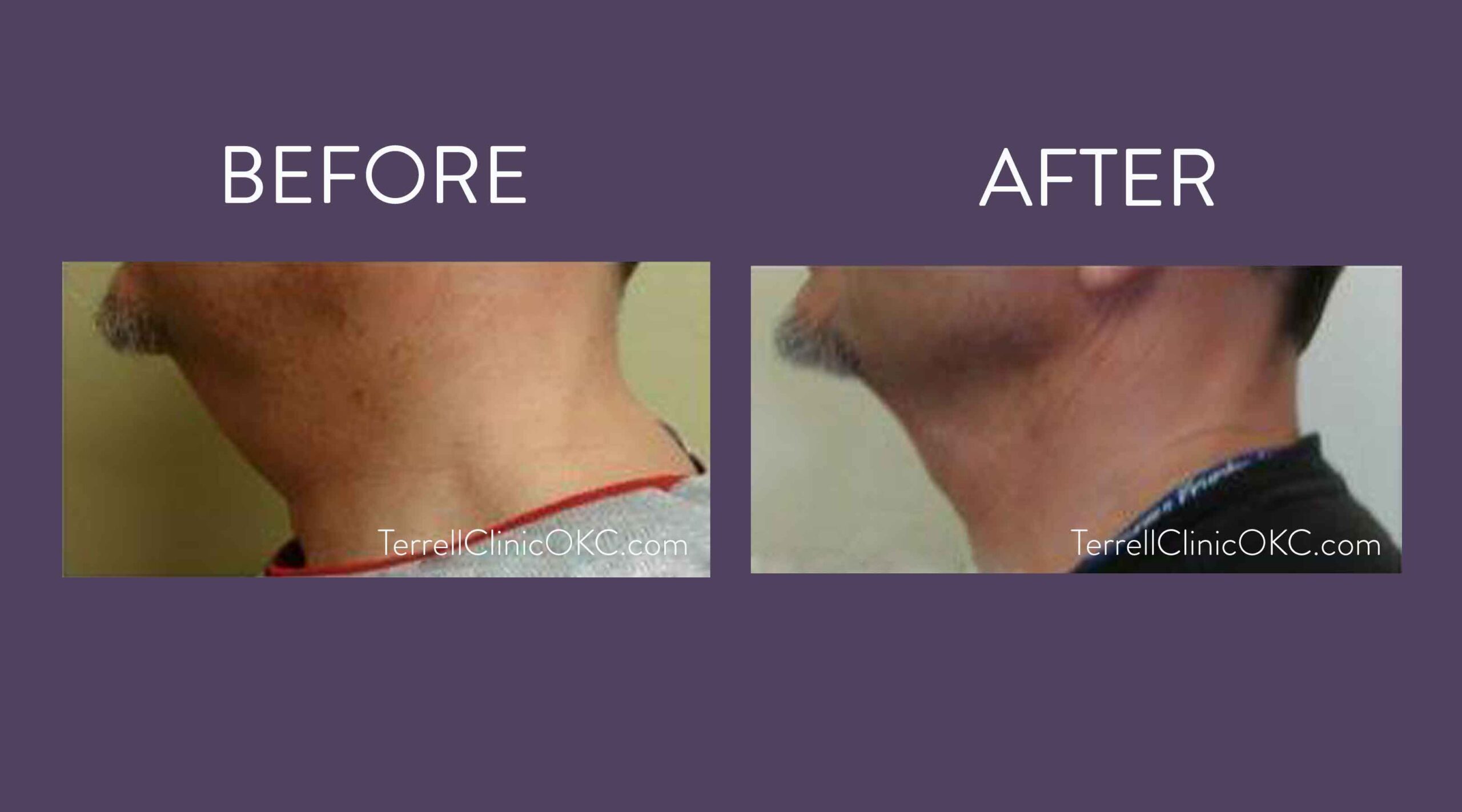 Chin and Neck Liposuction