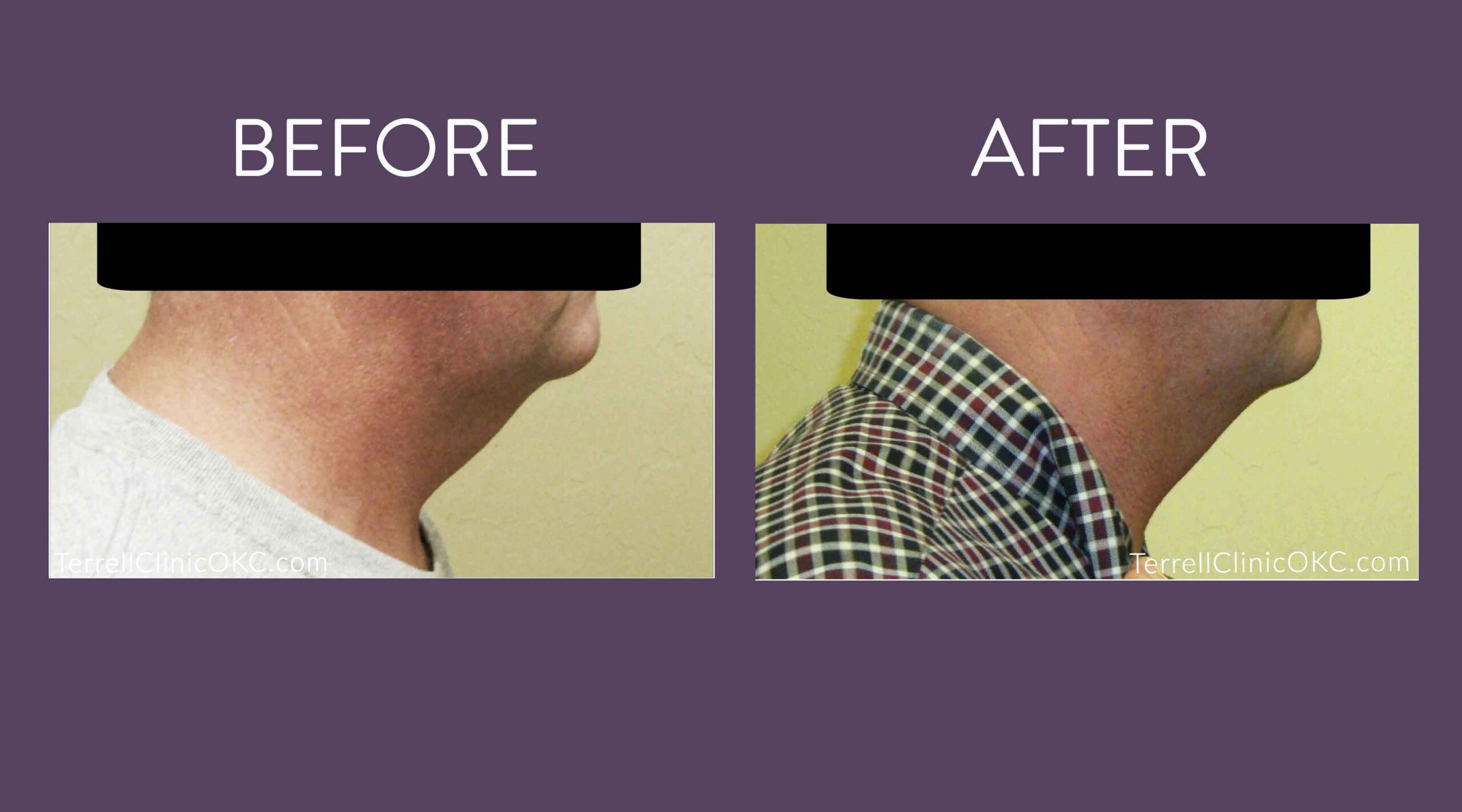 Chin and Neck Liposuction
