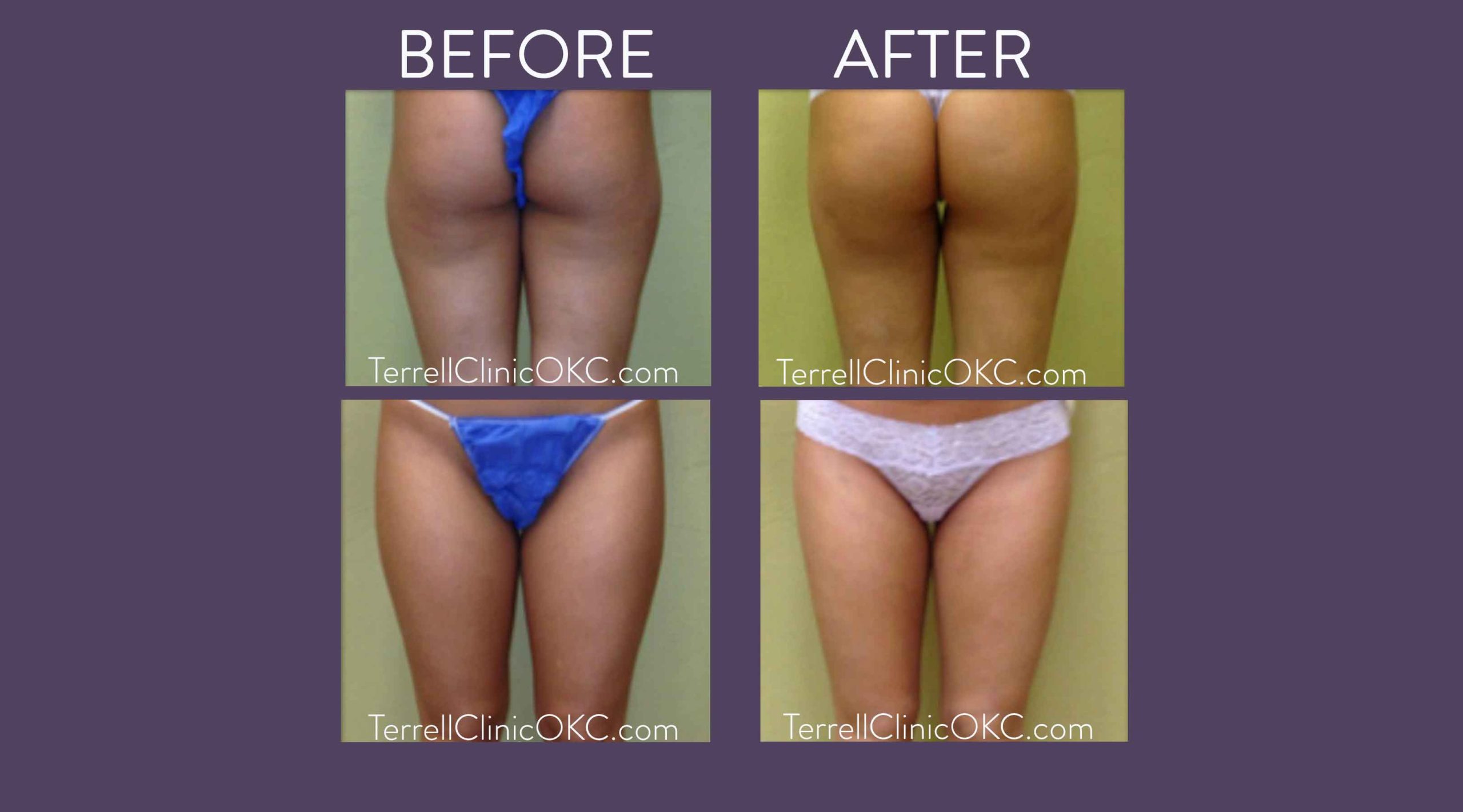 Outer Thighs Liposuction - KleinLipo - Liposuction Surgery of