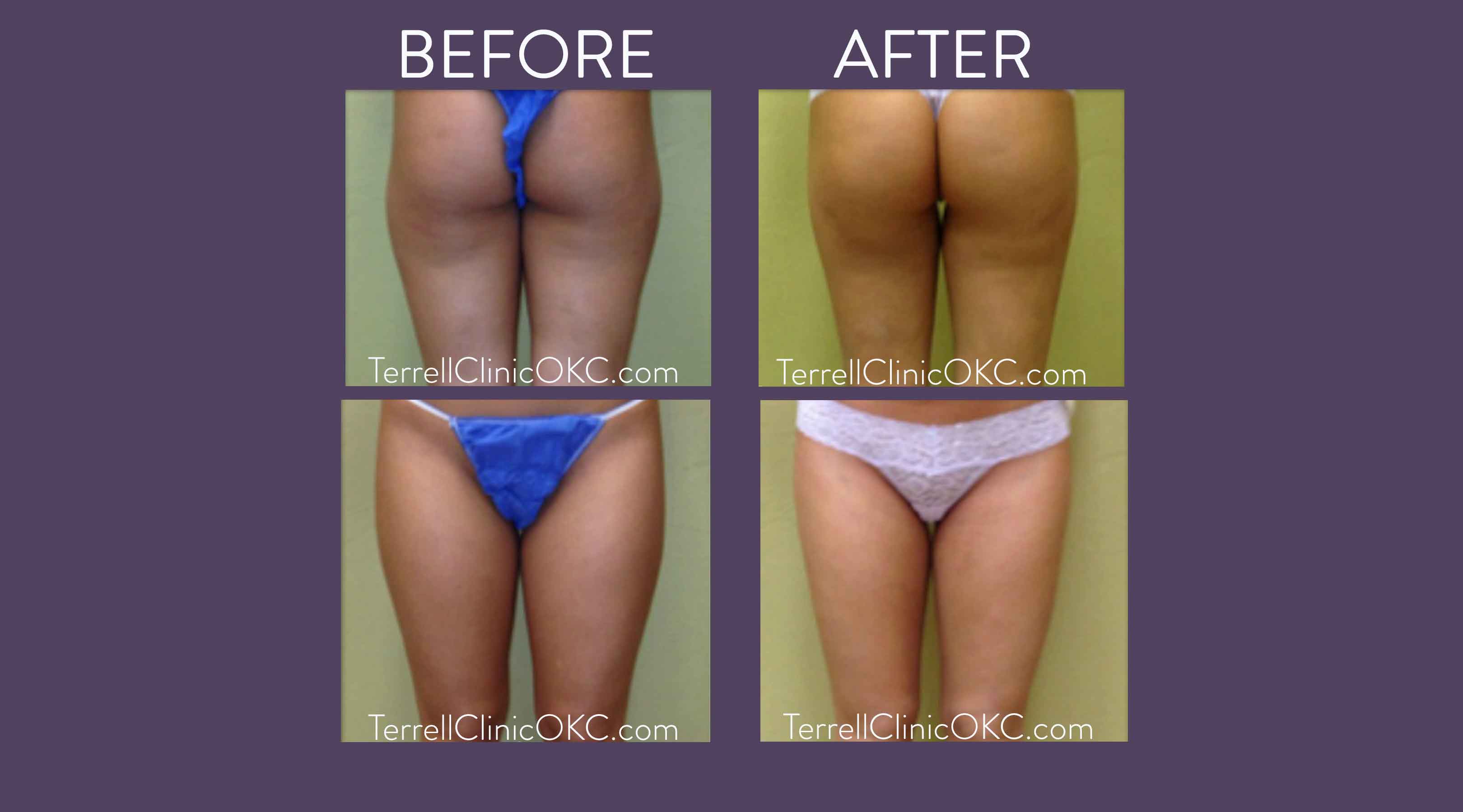 Smart Liposuction in Lynchburg, VA