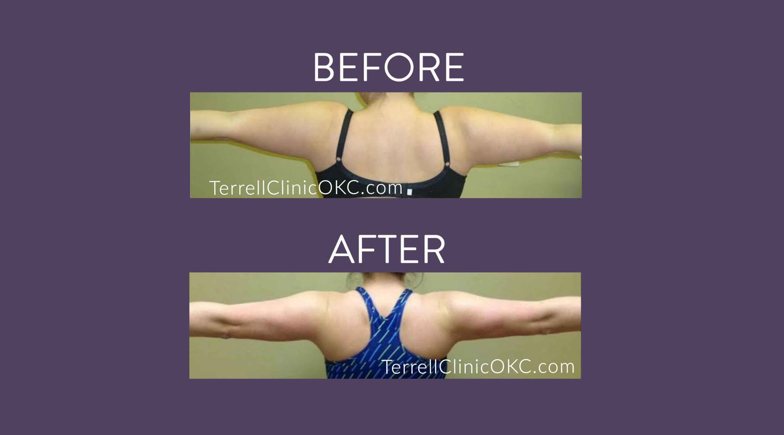 Circumferential Upper Arms Liposuction