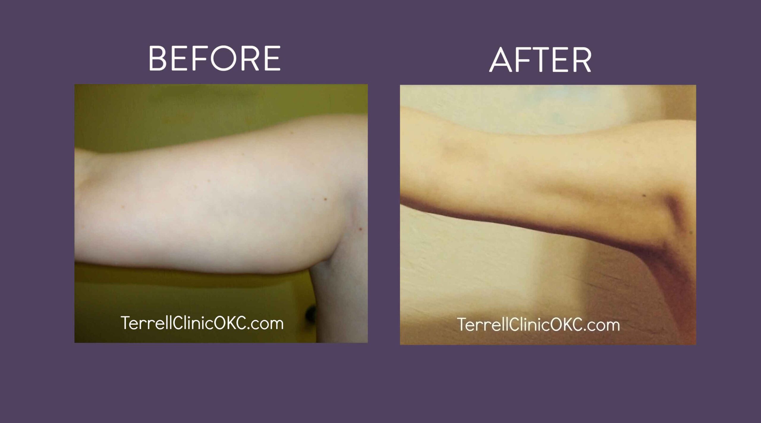 Circumferential Upper Arms Liposuction