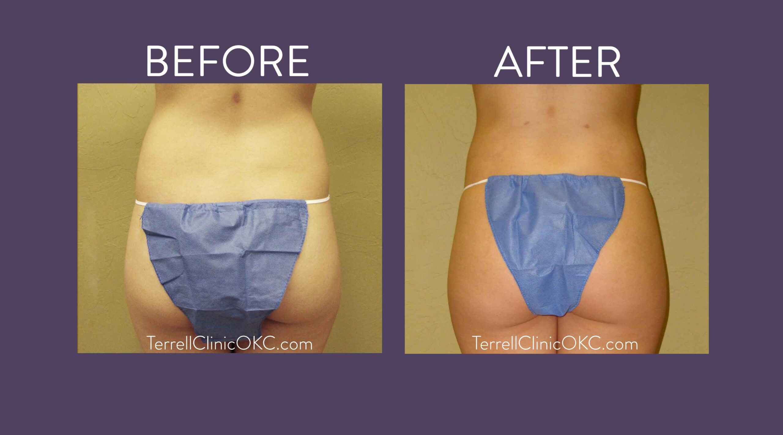 Upper and Lower Abdomen and Flank Liposuction, Inner and Outer Thigh Liposuction with Fat Transfer to Buttocks