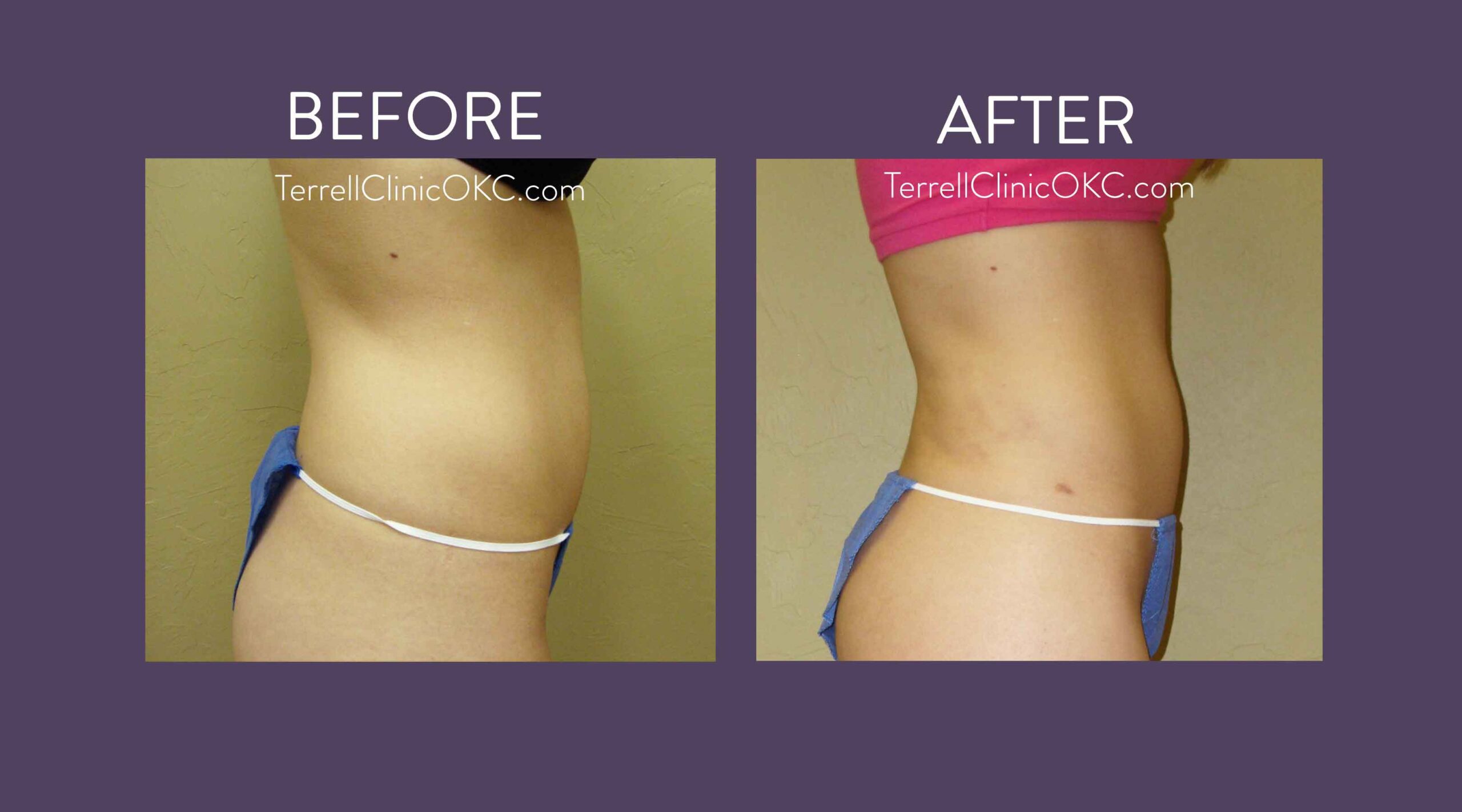 Upper and Lower Abdomen and Flank Liposuction, Inner and Outer Thigh Liposuction with Fat Transfer to Buttocks