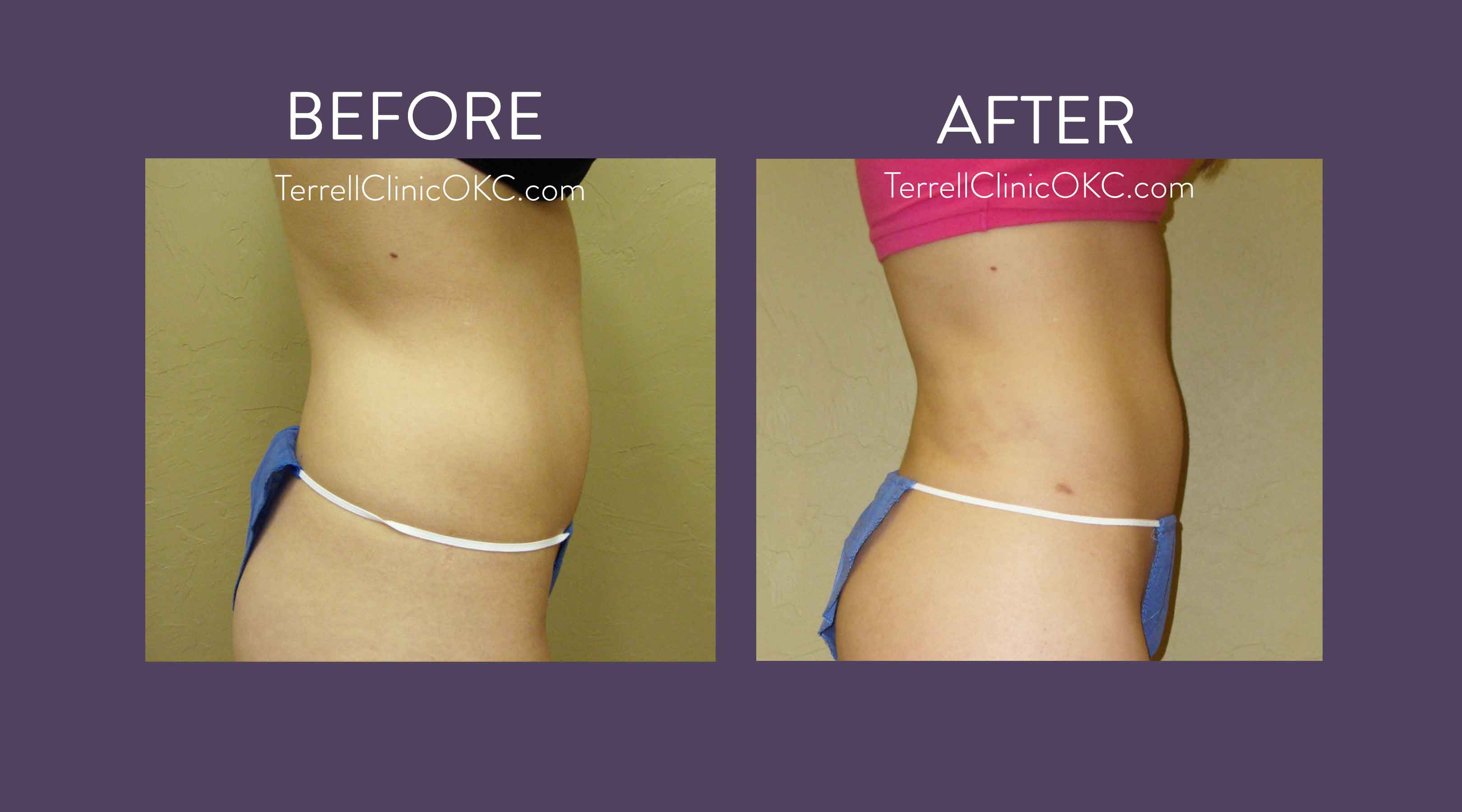 Upper and Lower Abdomen and Flank Liposuction, Inner and Outer Thigh  Liposuction with Fat Transfer to Buttocks - Terrell Clinic, flanks