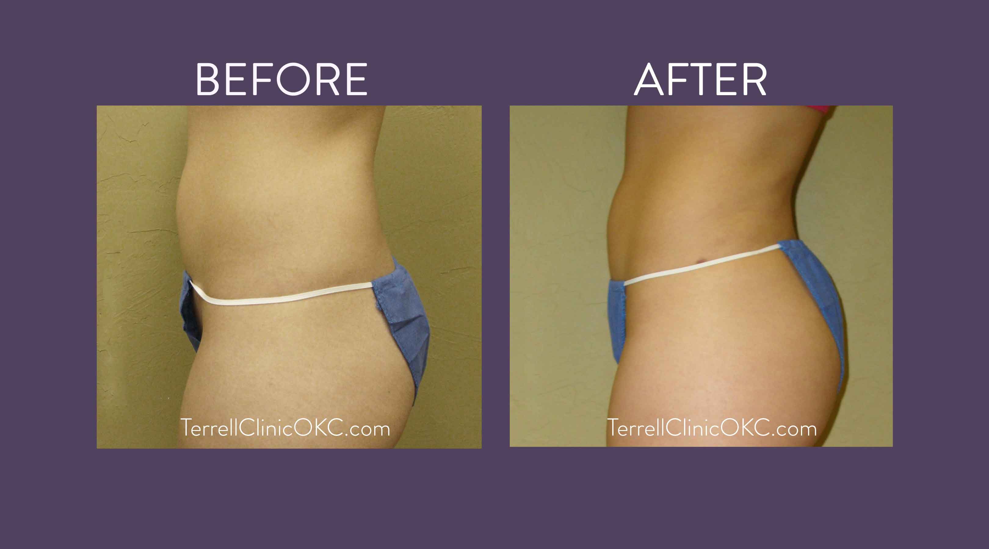 Liposuction of Flanks Before and After 3804