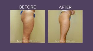 Inner and Outer Thigh Liposuction