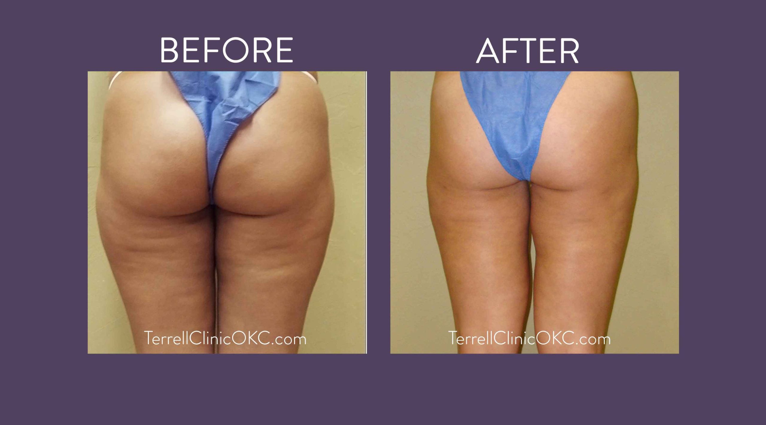 Inner and Outer Thigh Liposuction