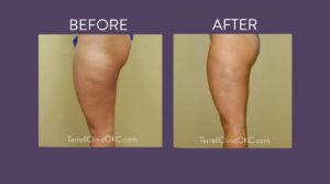 Inner and Outer Thigh Liposuction