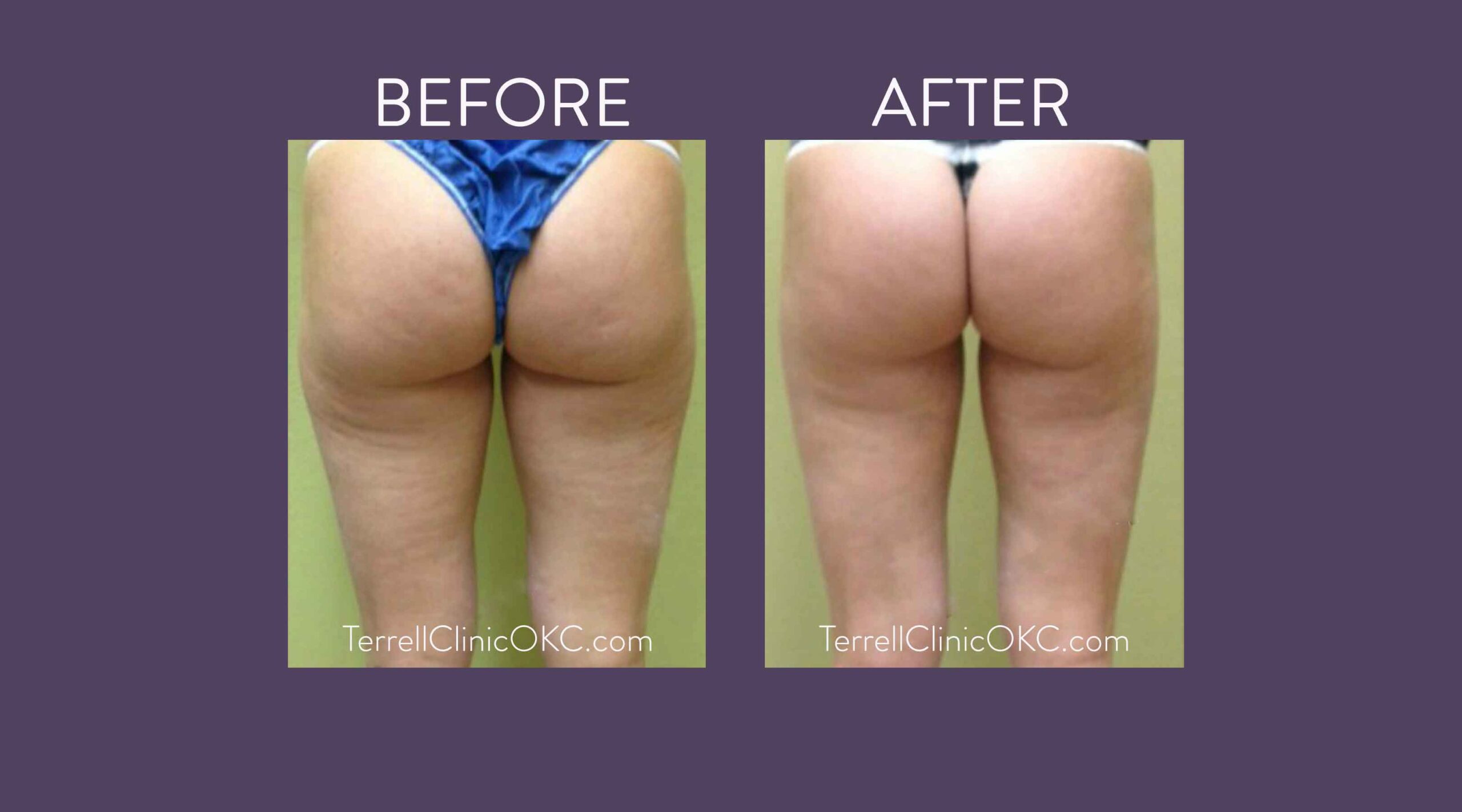 Inner and Outer Thigh Liposuction