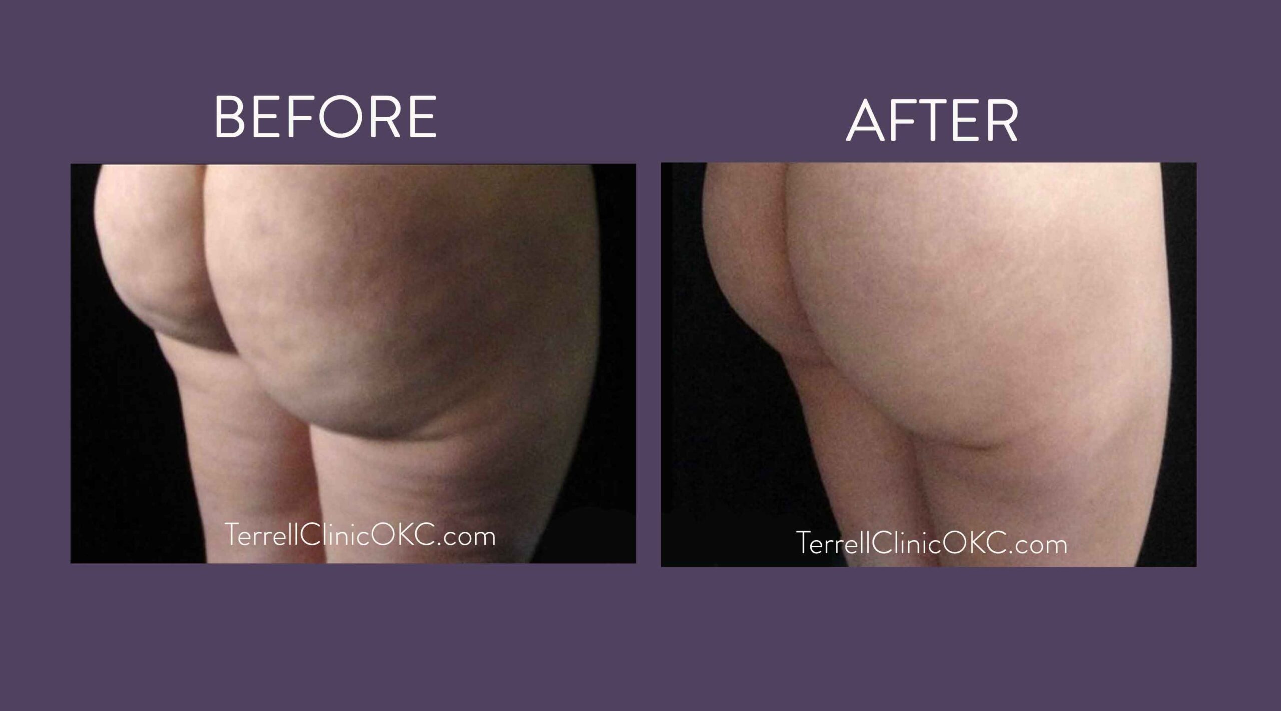 Upper and Lower Abdomen and Flank Liposuction, Inner and Outer Thigh Liposuction with Fat Transfer to Buttocks