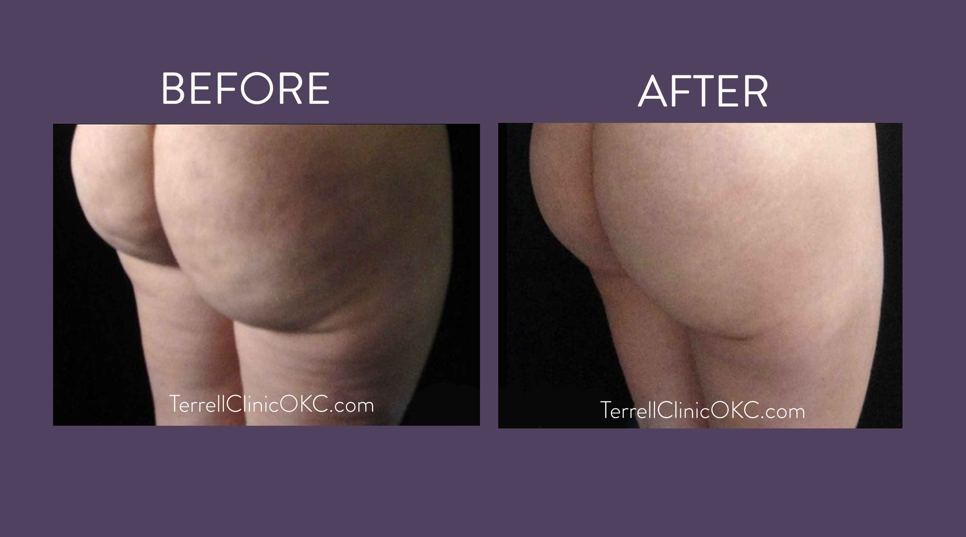 Upper and Lower Abdomen and Flank Liposuction, Inner and Outer Thigh  Liposuction with Fat Transfer to Buttocks - Terrell Clinic