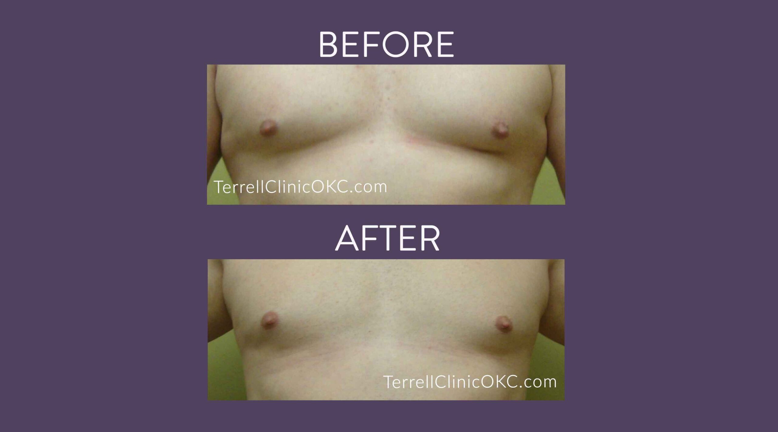 Male Chest Liposuction
