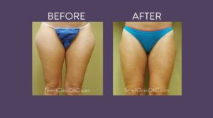 Inner and Outer Thigh Liposuction
