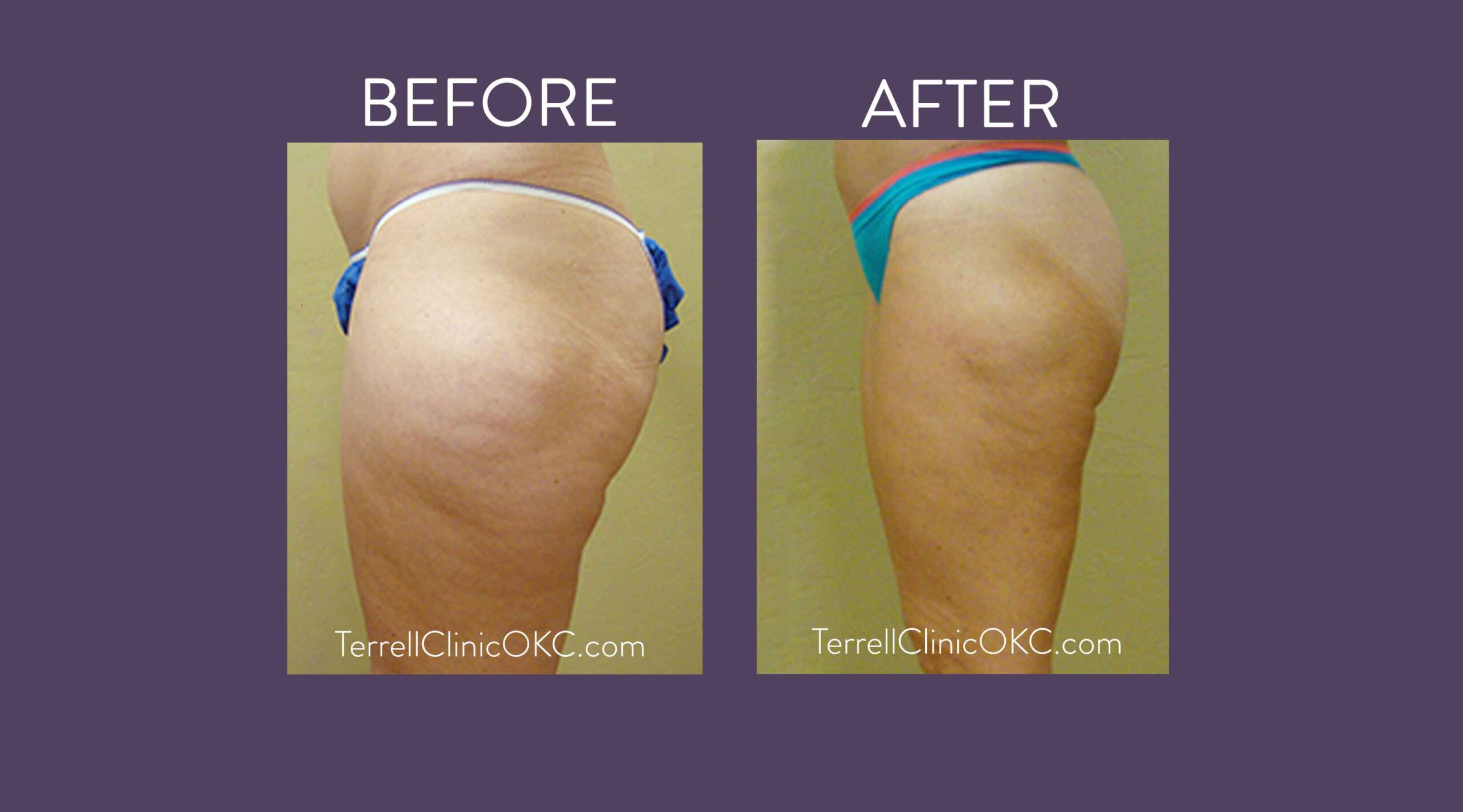Inner and Outer Thigh Liposuction
