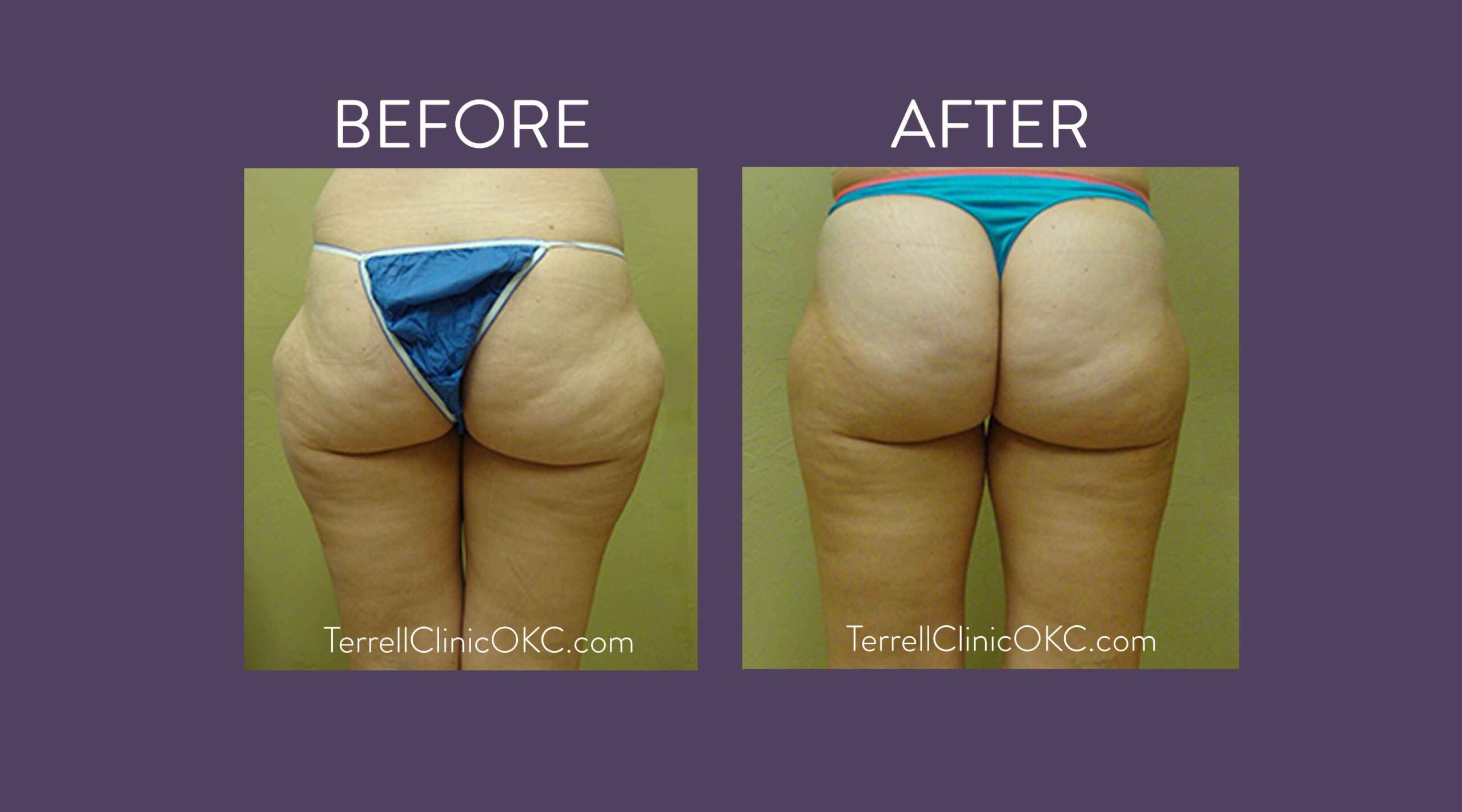 Inner and Outer Thigh Liposuction