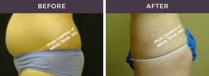 Smart Liposuction Before and After