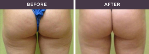 Smart Liposuction Before and After
