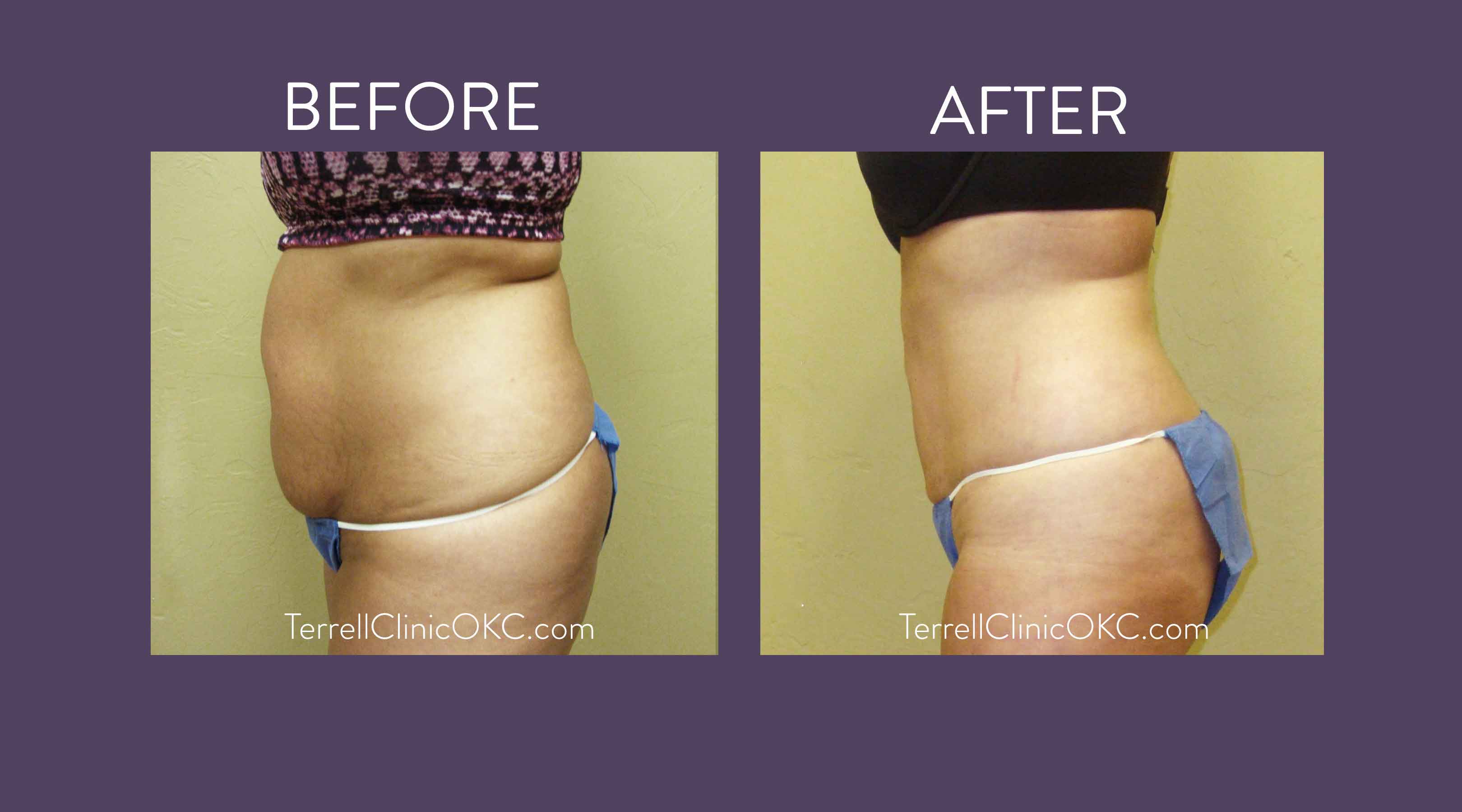 Can You Get a Flat Stomach From Lipo? - Dr. Kadz
