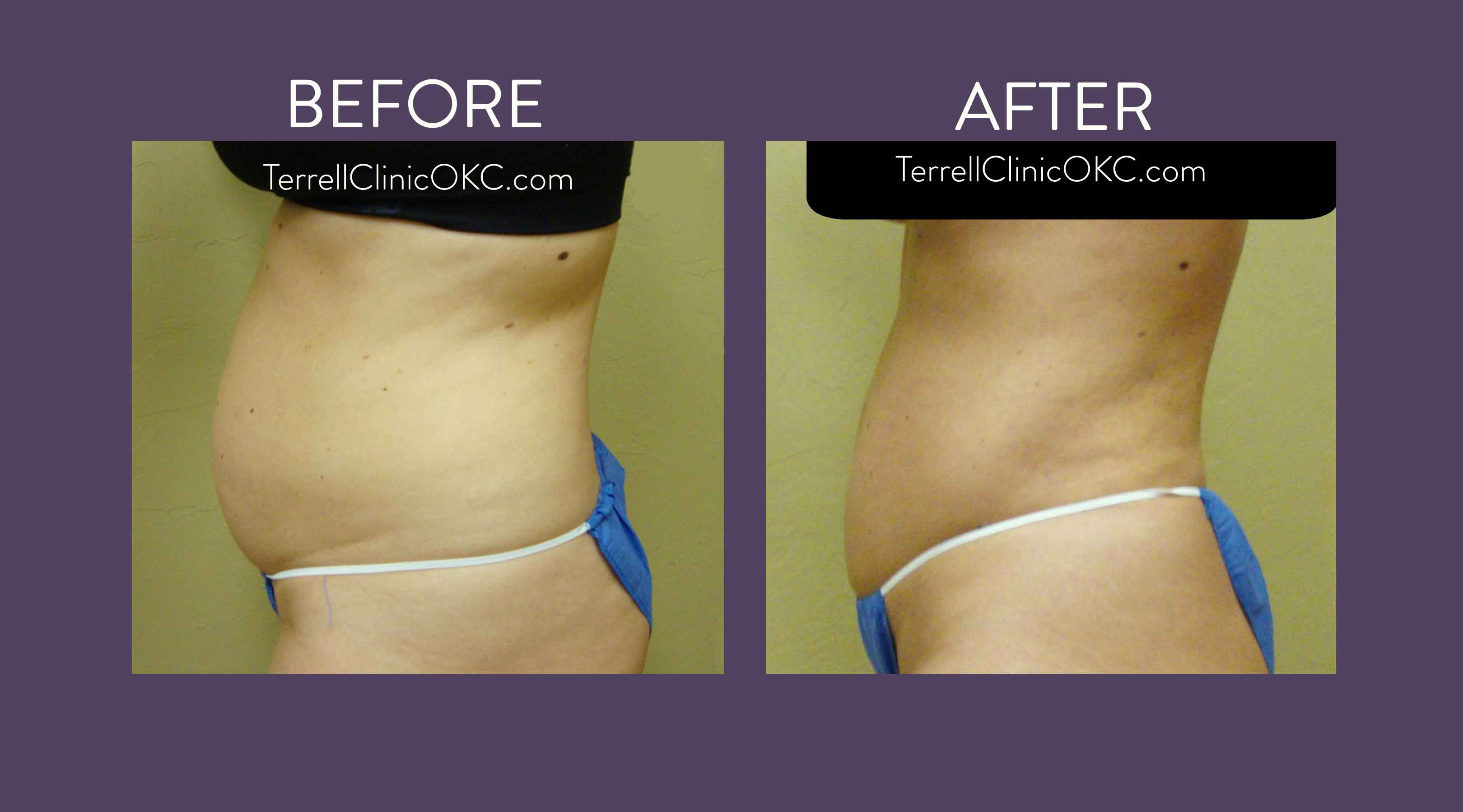 CoolSculpting for Back Fat - Dr. Michele Green M.D.