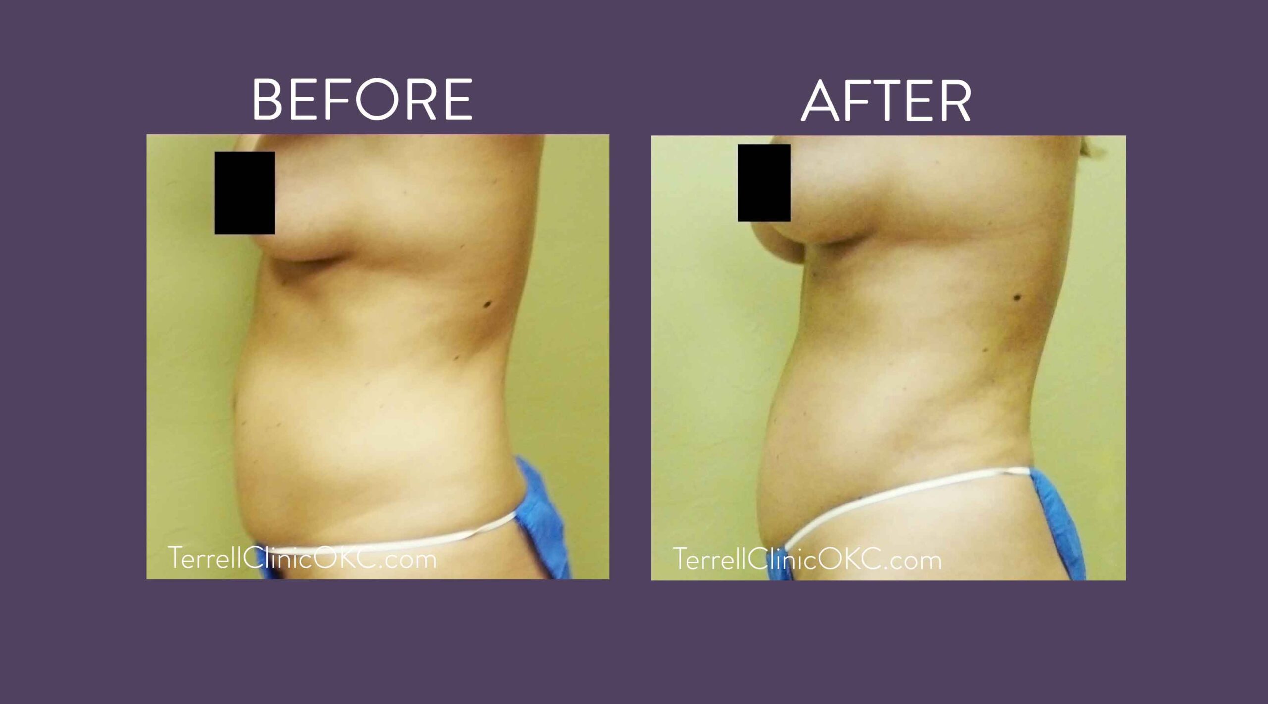 Upper and Lower Flank and Abdomen Liposuction with Fat Transfer to Breasts