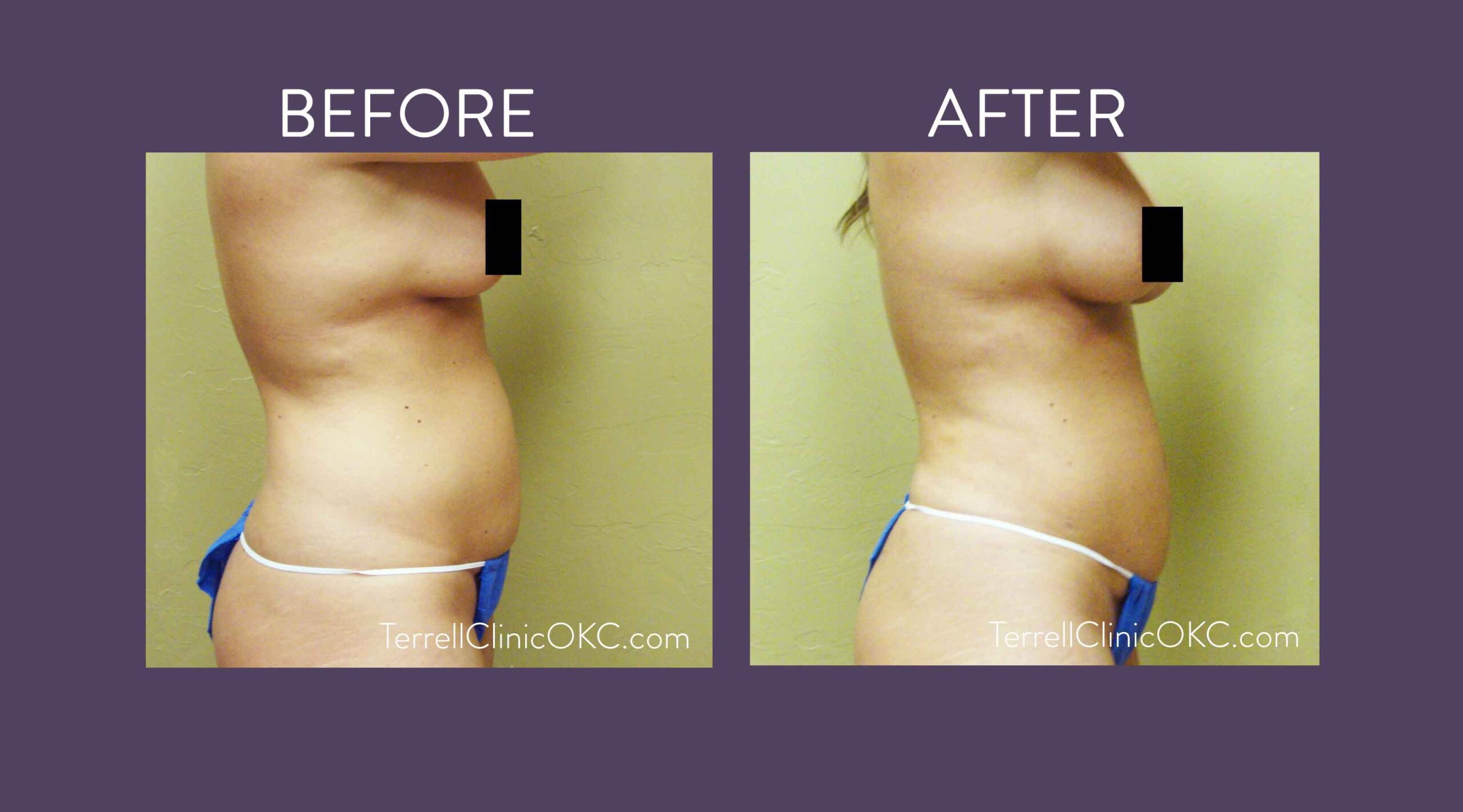 Upper and Lower Flank and Abdomen Liposuction with Fat Transfer to Breasts