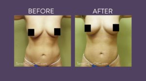 Upper and Lower Flank and Abdomen Liposuction with Fat Transfer to Breasts