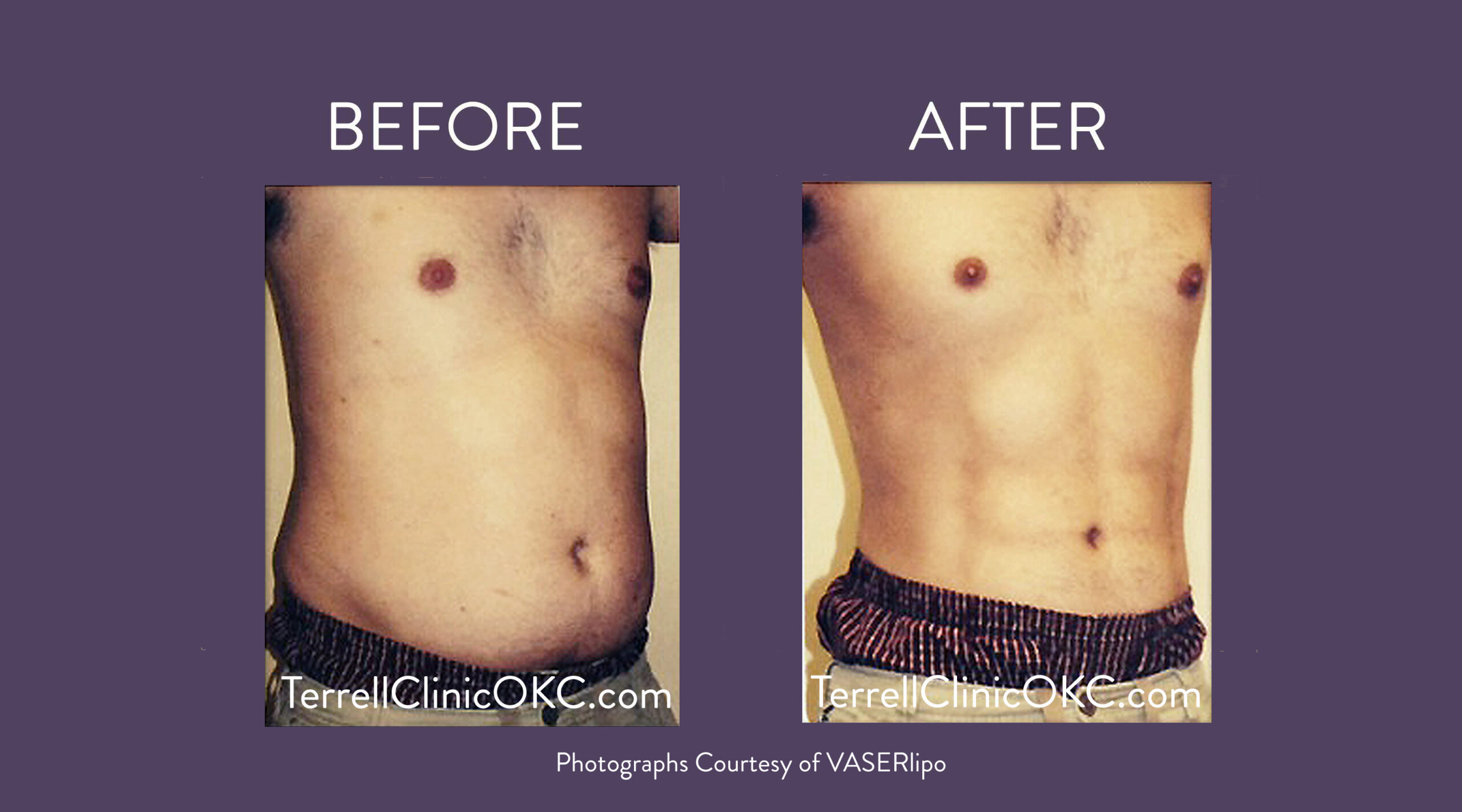 Abs and Chest Liposuction