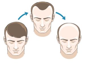 balding-cycle