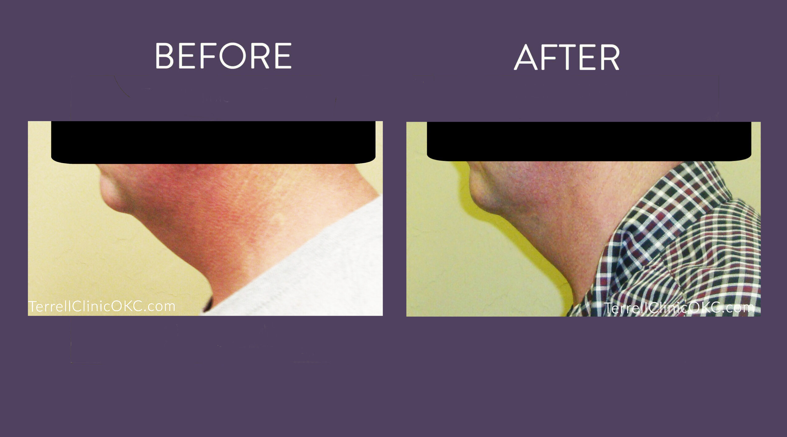 Chin and Neck Liposuction