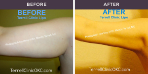 Liposuction Before and After circumferential upper arms