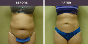 Liposuction Before and After