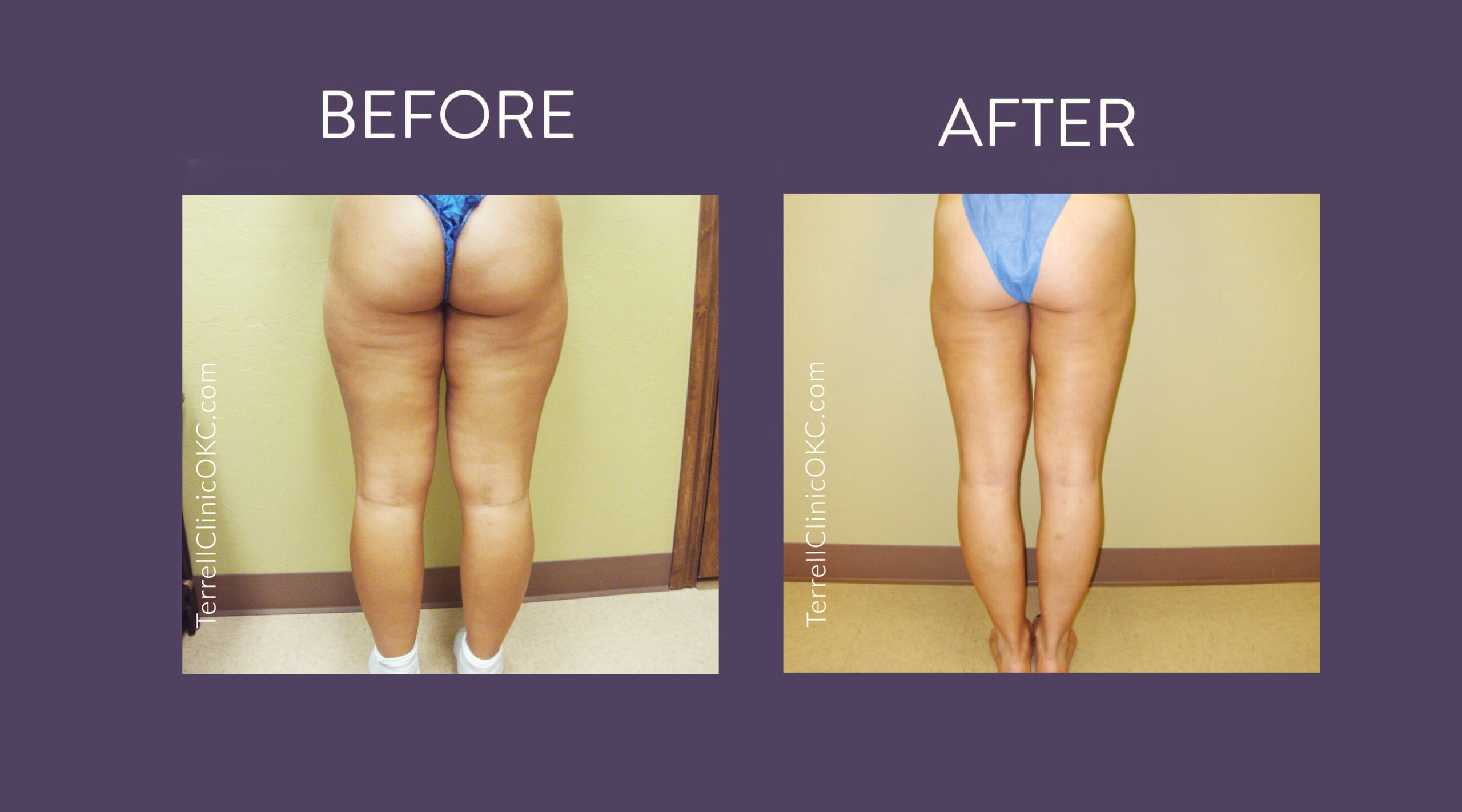 Inner and Outer Thigh Liposuction