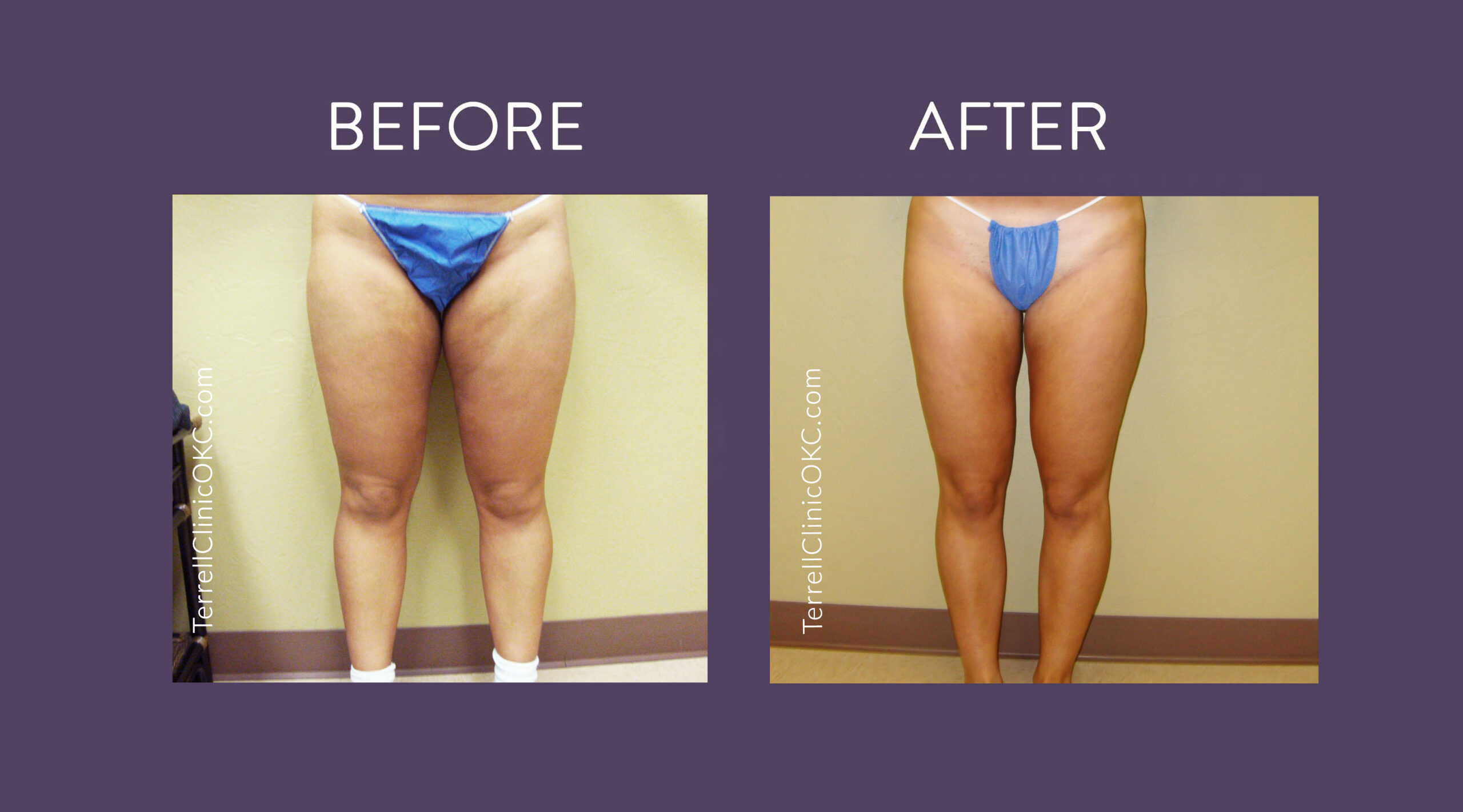 Inner and Outer Thigh Liposuction