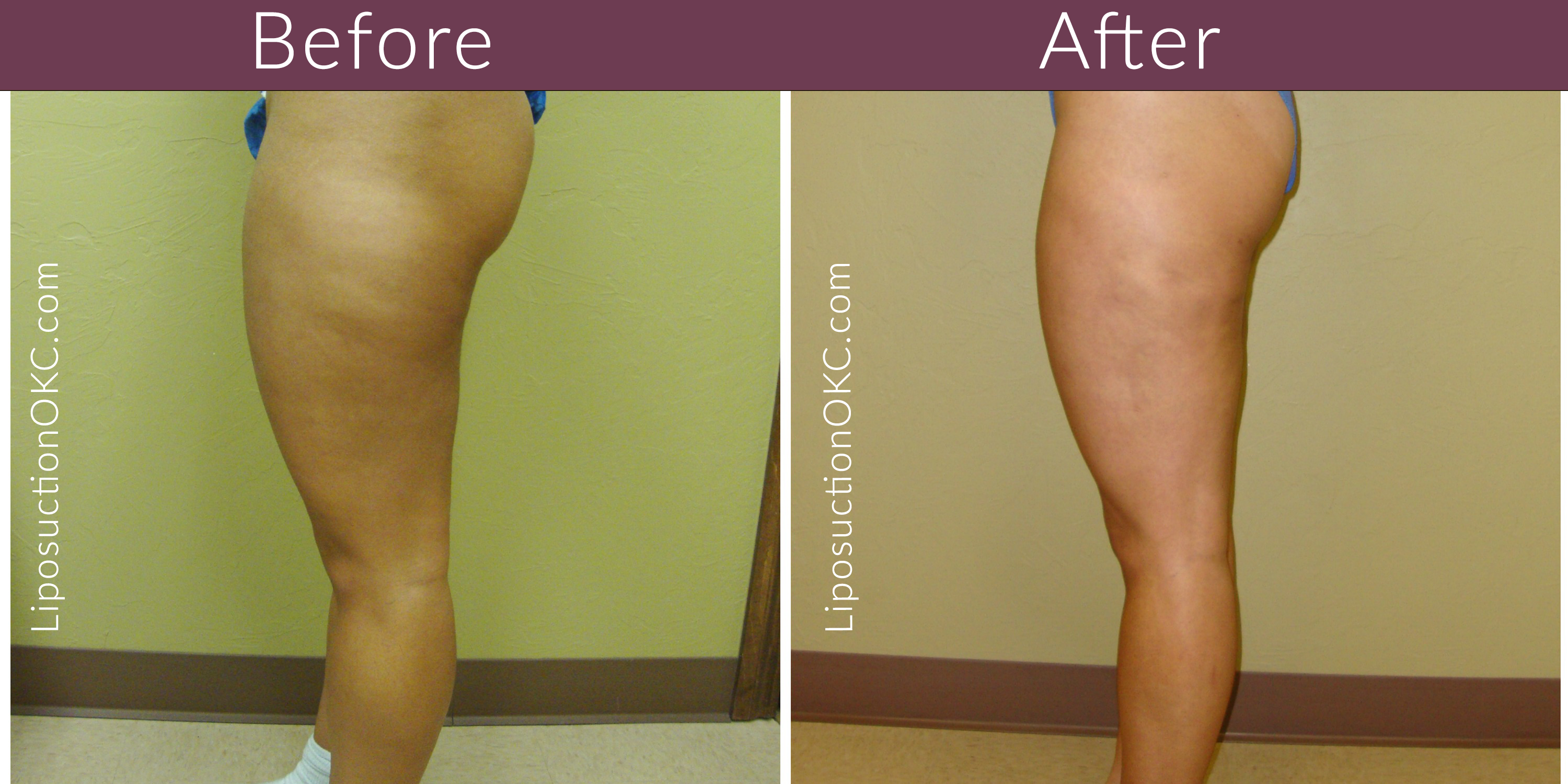 Vasersmooth Advanced Liposuction Terrell Clinic In Okc 