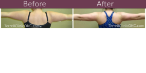 arm liposuction