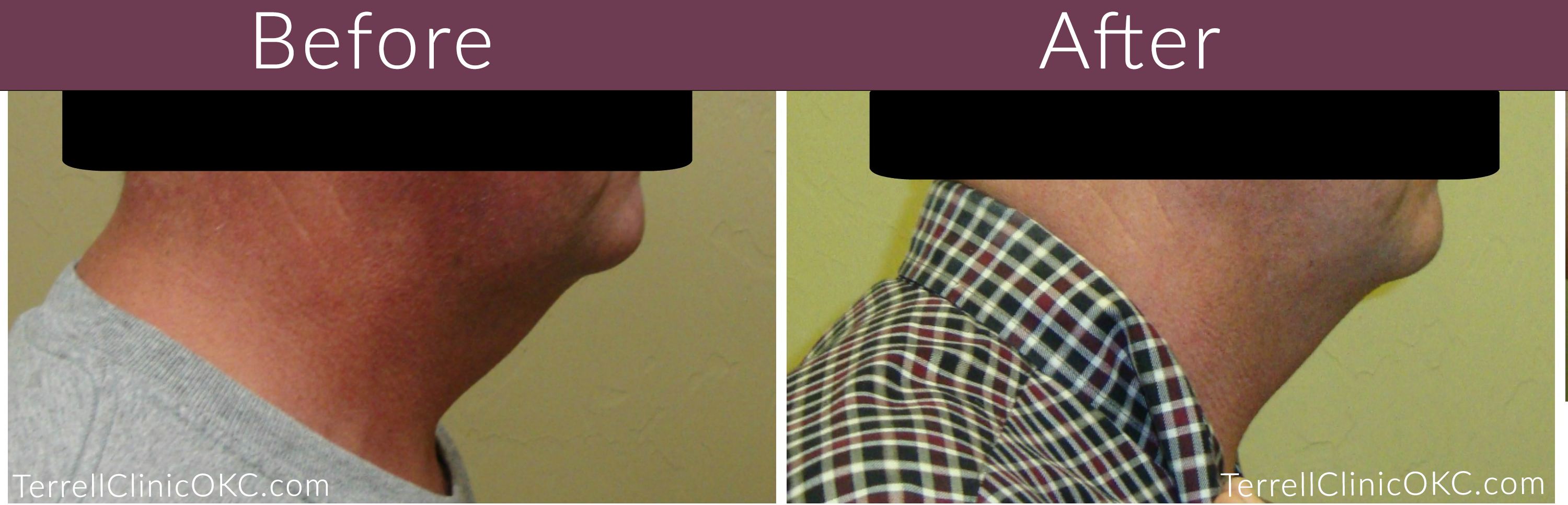 tc-before-after-chin2-e1486406808465.png
