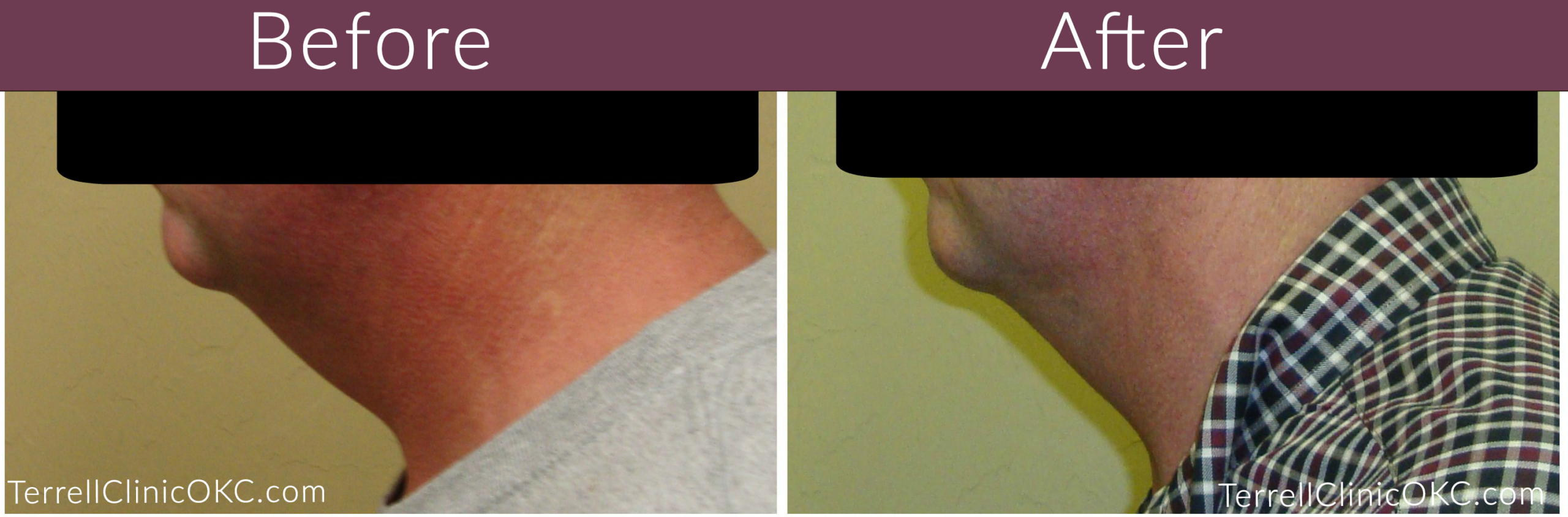 Chin and Neck Liposuction